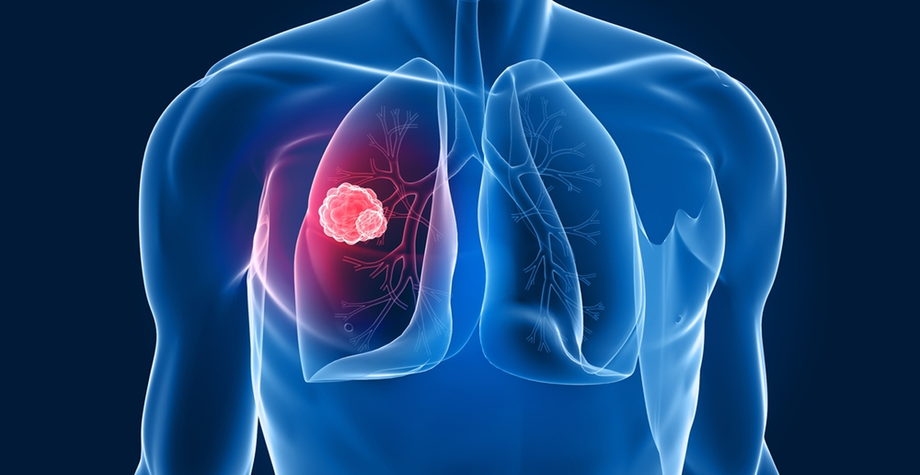 What Is Mesothelioma? | Recommended Mesothelioma Products
